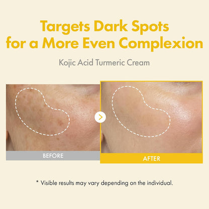 TOSOWOONG Kojic Acid Turmeric Cream, 99% Purity Kojic Acid 7,000ppm, 660,941ppm Turmeric, Dark Spot Corrector Capsule for Hyperpigmentation & Even Skin Tone Care, Korean Skincare, 50ml / 1.69 fl. oz.