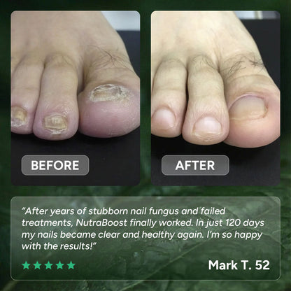 Nail Fungus Treatment Gel